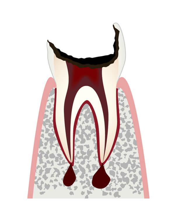むし歯がかなり進行し歯の根っこだけが残った状態